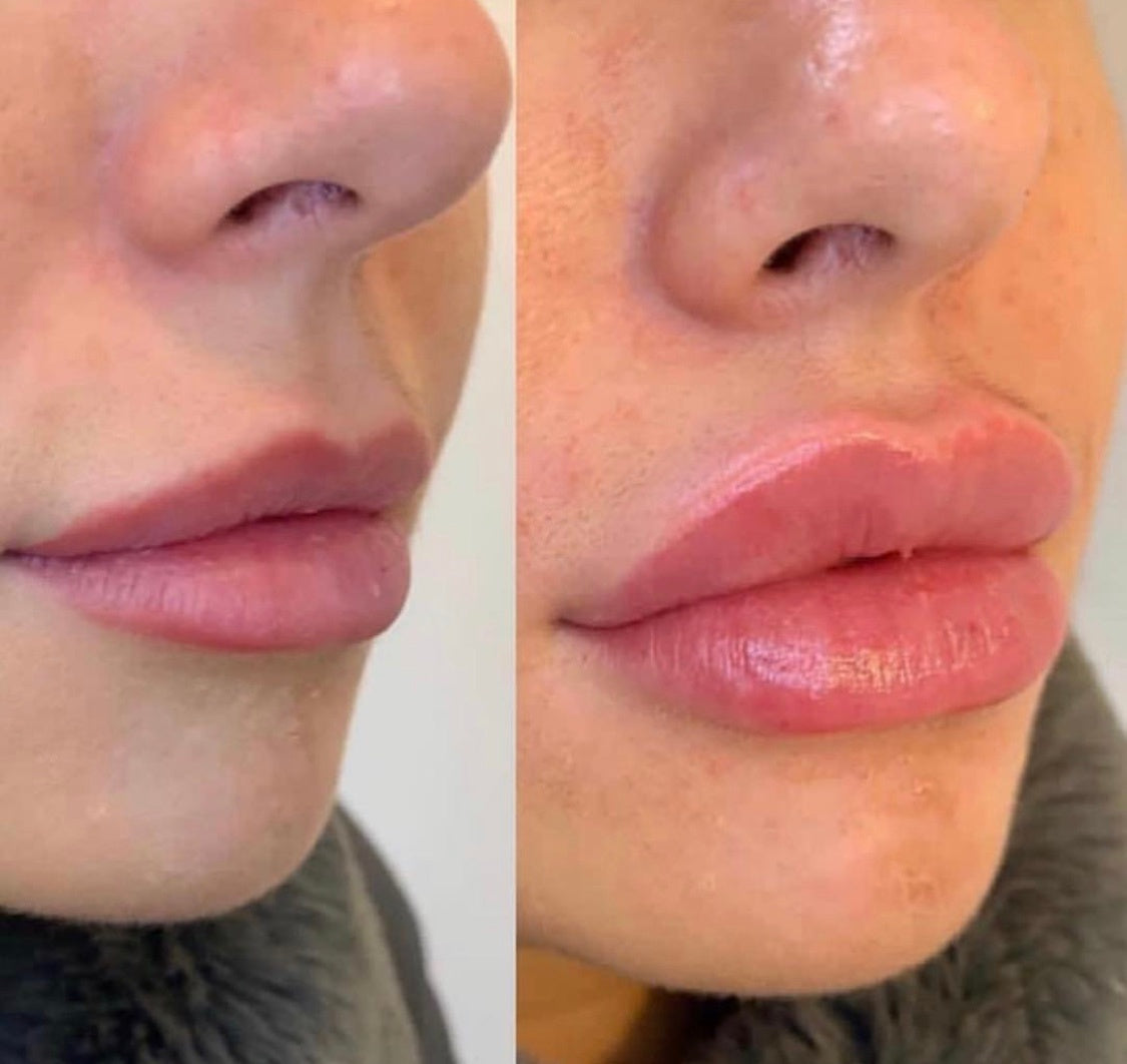 Online Hyaluron Pen Certification Course Plush Beauty Academy